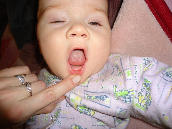 Почему у новорожденных слюни. Стоматит в языкы у ребенка.