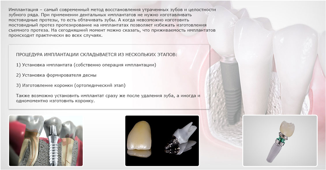 Имплант после удаления зуба. Методы дентальной имплантации. Процедура имплантации зуба. Современные методы имплантации зубов. Этапы стоматологической имплантации.