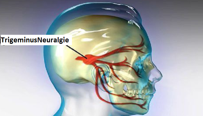 Воспаление нерва можно ли греть. Невралгия тройничного нерва. Тригеминальная невралгия тройничного нерва. Тройничный нерв неврология. Невралгия 2 ветви тройничного нерва.