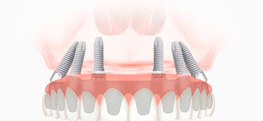Все На 6 Имплантах Цена Под Ключ