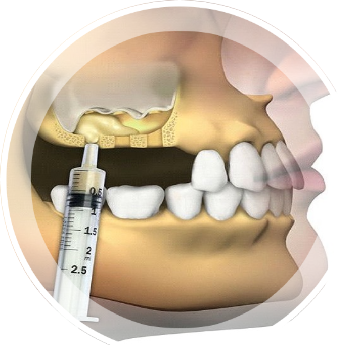 Восстановление костной ткани зубов. Остеотомный синус лифтинг. Имплантирование синус лифтинг. Синус-лифтинг (костная пластика, остеопластика) закрытый.