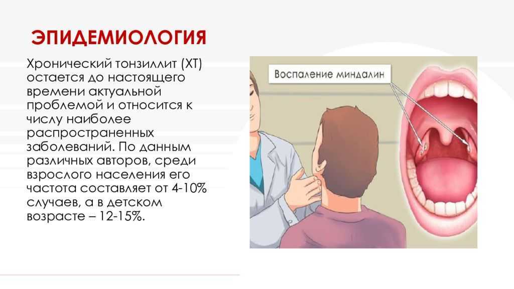 Тонзиллит схема. 1 Форма хронического тонзиллита. Хронический тонзиллит ТАФ 1. Презентация на тему тонзиллит. Тонзиллит симптомы у ребенка 5 лет.