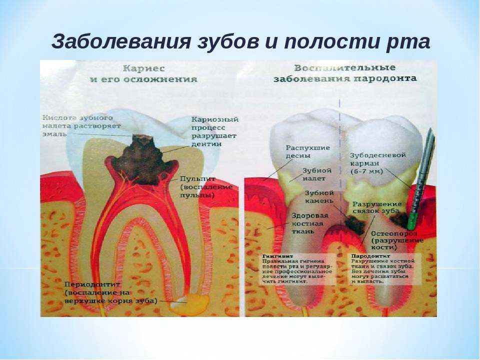 Виды кариеса зубов с картинками