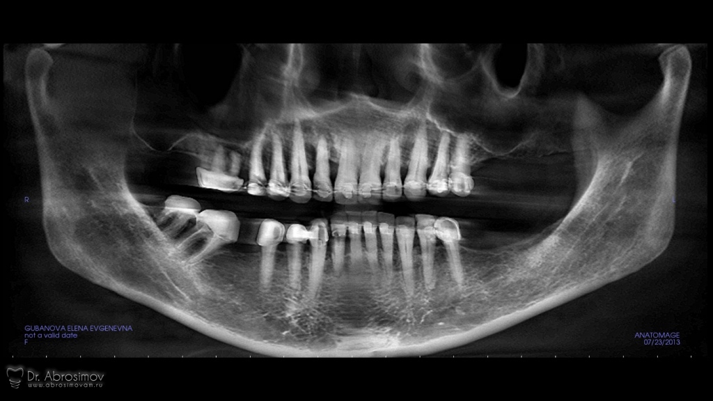 Где сделать панорамный снимок. Остеопороз ортопантомограмма.