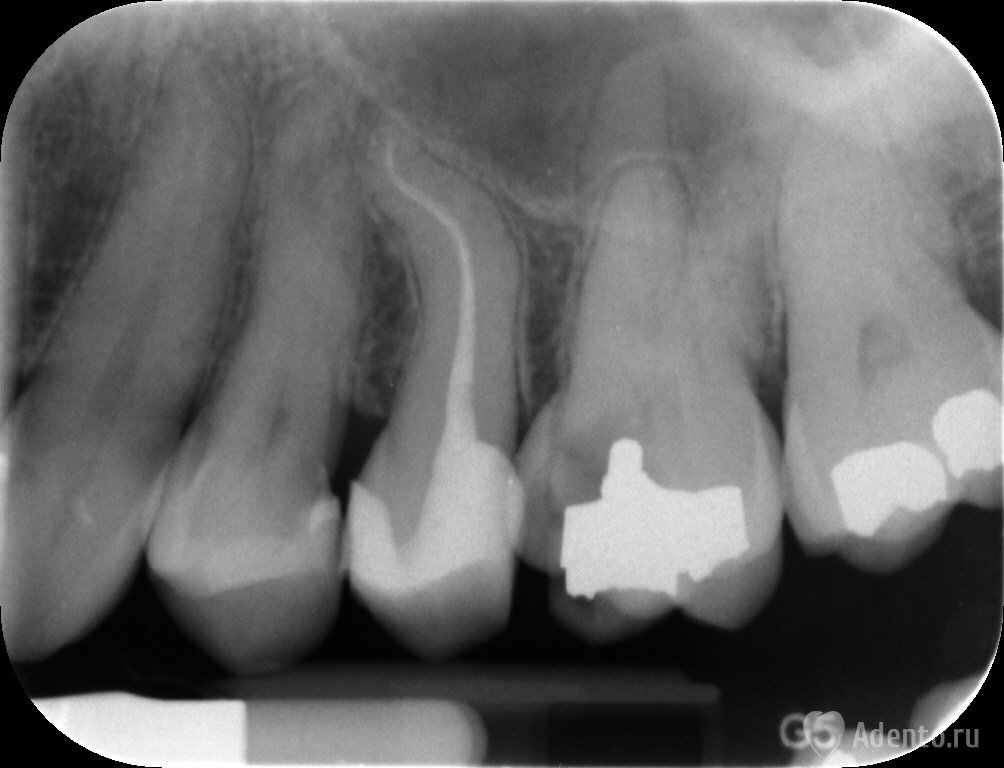 Прицельный снимок. Пульпит 17 зуба рентген с запломбированными каналами. Прицельный снимок периодонтит. Пульпит на рентгеновском снимке.