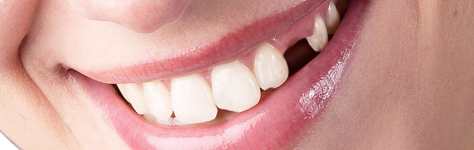 Сонник выпадение зубов без. Раскрылся зуб фото. Передний зуб выпирает вперед фото. Причины выпадения зубов фото.