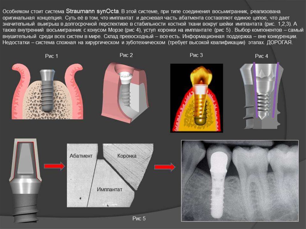 Импланты зубов схема установки