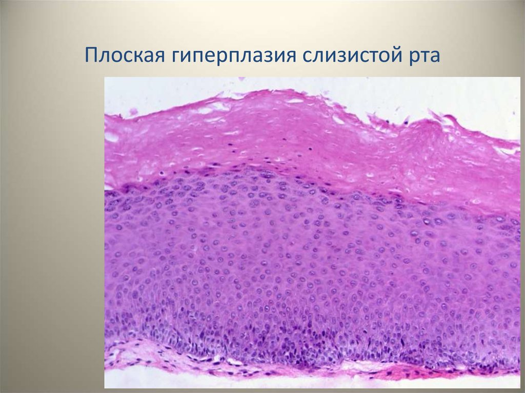 Слизистая полости. Псевдоэпителиоматозная гиперплазия гистология. Веррукозная лейкоплакия гистология. Сосочковая гиперплазия гистология. Воспалительная гиперплазия.