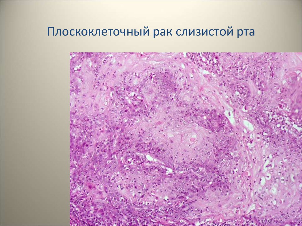 Слизистый рак. Интраэпителиальная карцинома слизистой полости рта. Плоскоклеточный некроз. Злокачественная опухоль макропрепарат.