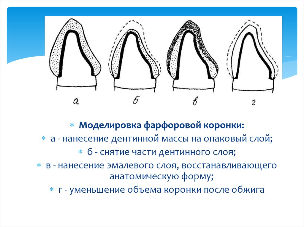 Препарирование под металлическую штампованную коронку