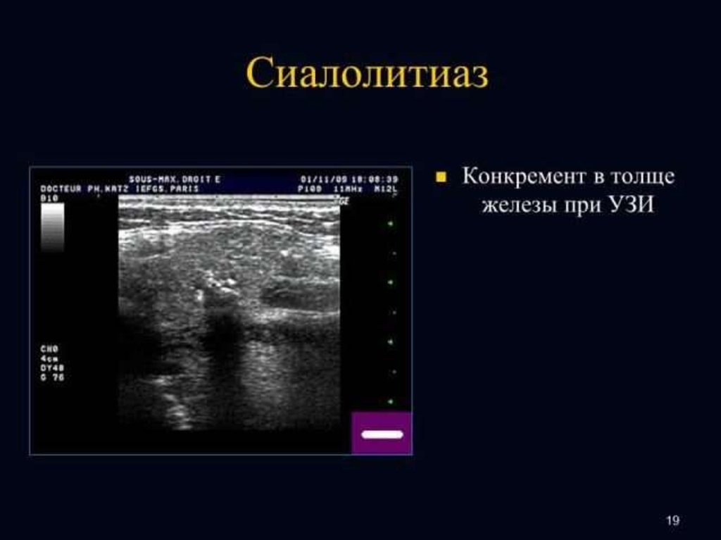 Лучевая диагностика заболеваний слюнных желез презентация