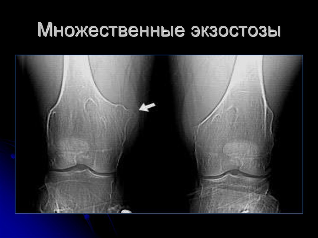 Экзостоз. Множественные экзостозы. Множественные хрящевые экзостозы. Множественные костные экзостозы. Экзостозное заболевание.