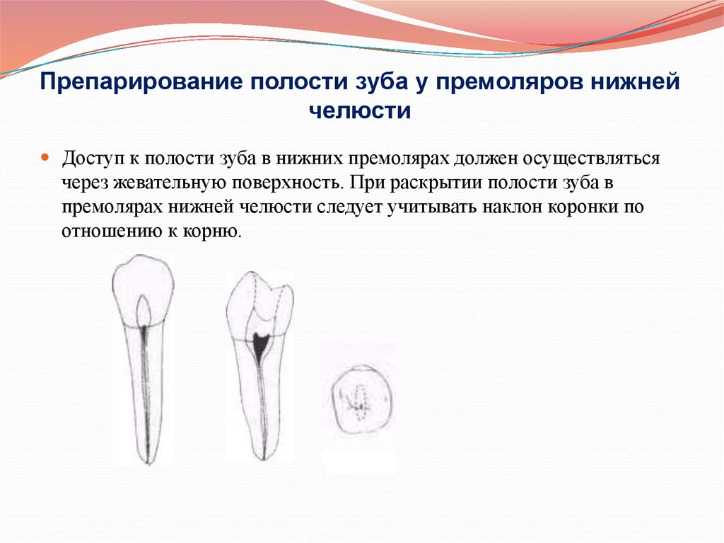 Препарирование корневого канала. Полость зуба первых премоляров. Раскрытие полости зуба премоляров верхней челюсти. Раскрытие полости зуба премоляров нижней челюсти. Подход к полости зуба премоляров.