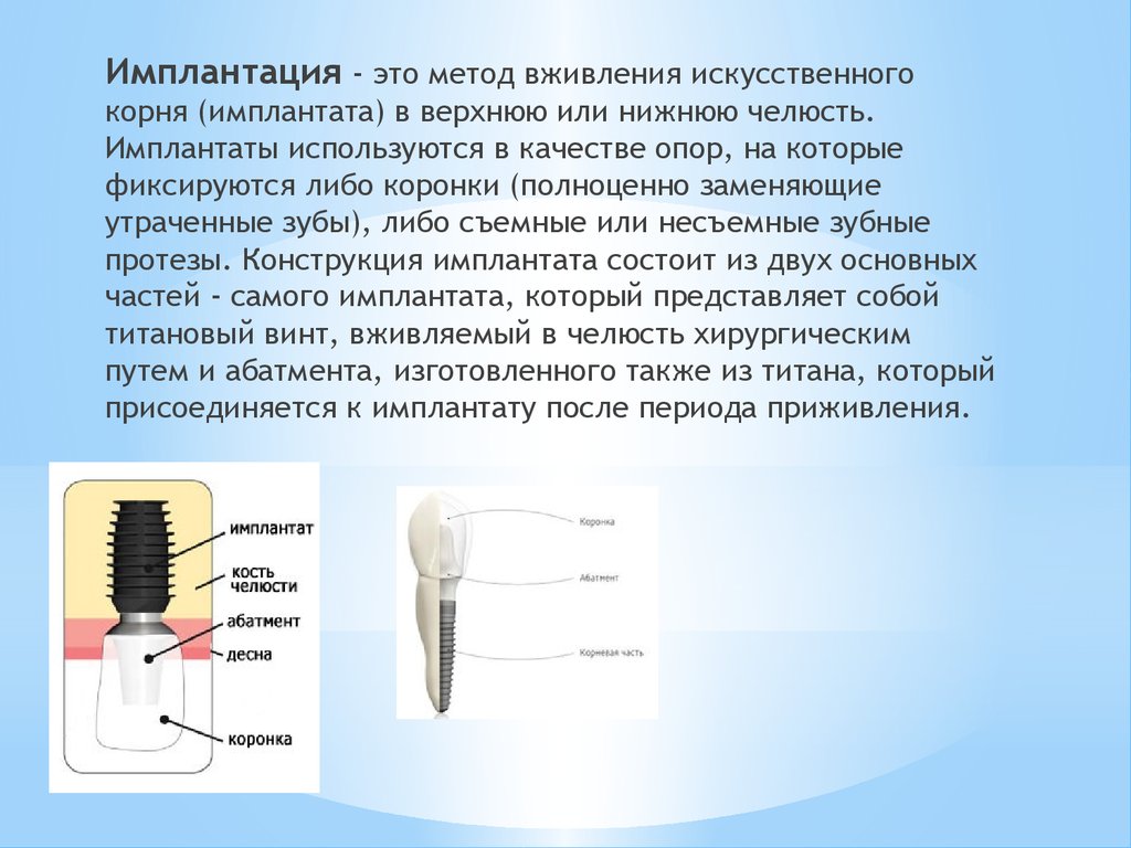 Имплант схема