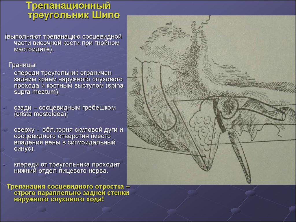 Сосцевидная кость. Треугольник шипо топографическая анатомия. Треугольник шипо границы. Трепанационный треугольник шипо. Область сосцевидного отростка и треугольника шипо.