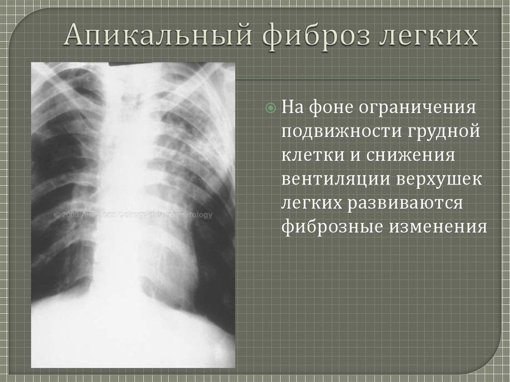 Фиброзные изменения тканей. Плевральные наслоения. Апикальные отделы легких.