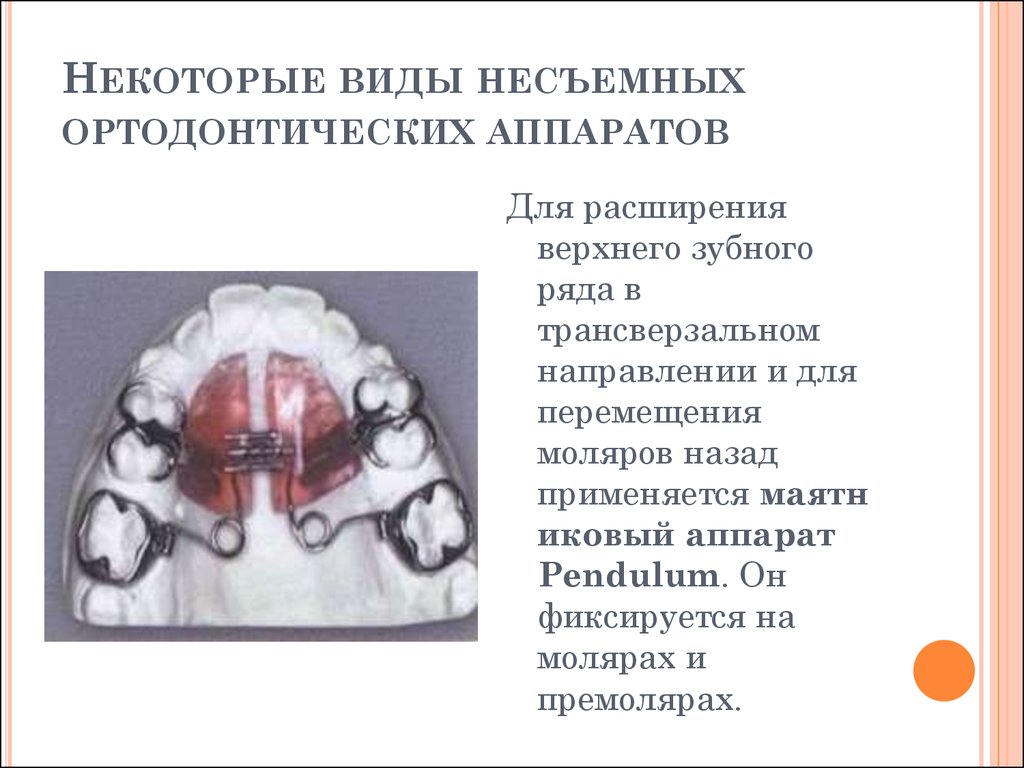 Некоторые виды. Ортодонтический аппарат Нормана Кинзли. Несъёмные внеротовые ортодонтические аппараты. Ортодонтическая коррекция несъемным аппаратом «Pendulum-pendex». Аппараты механического действия в ортодонтии классификация.