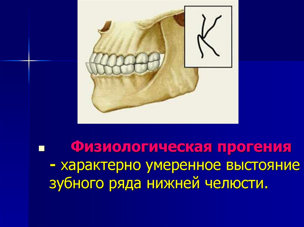 Мезиальная окклюзия презентация ортодонтия