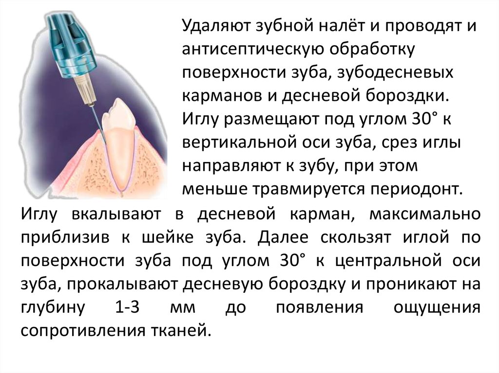 Анестезия удаление. Местная анестезия в стоматологии Оперативная хирургия. Десневой карман анатомия. Коагуляция десневого сосочка. Местная анестезия при удалении зуба.