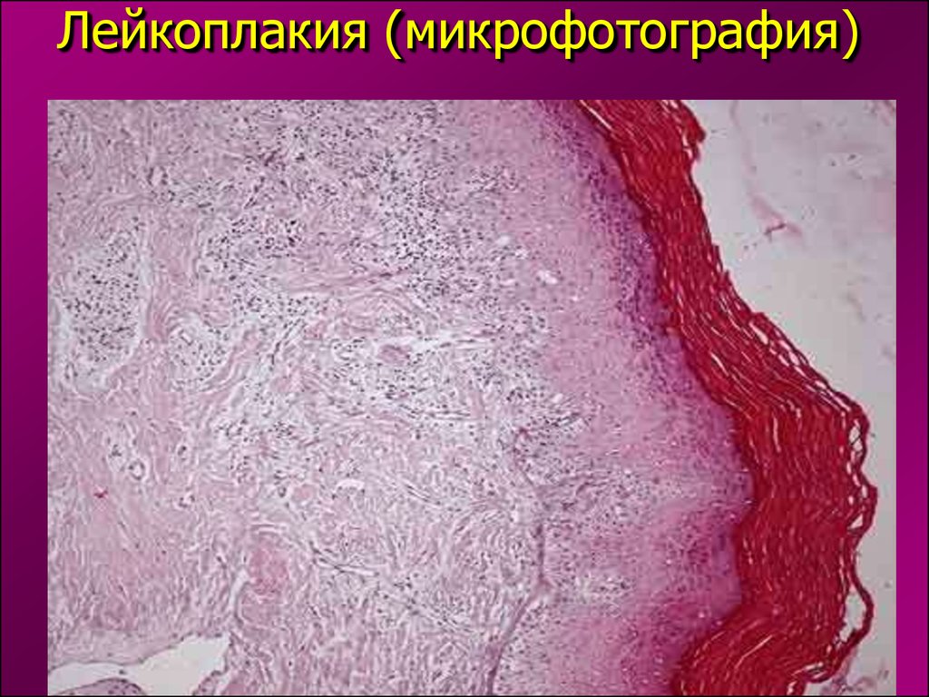 Крауроз. Веррукозная лейкоплакия гистология. Лейкоплакия вульвы гистология. Роговая дистрофия патанатомия.