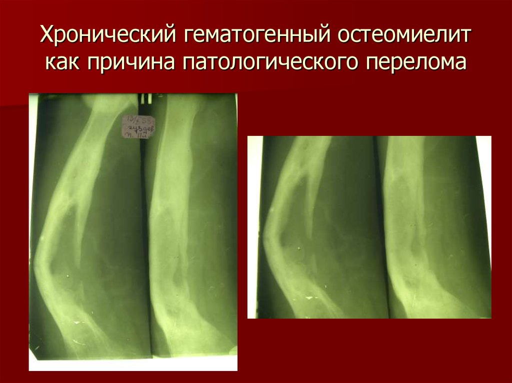 Гематогенный остеомиелит. Хронический гематогенный остеомиелит патогенез. Патогенез гематогенного остеомиелита. Клиническая картина острого гематогенного остеомиелита. Интрамедуллярная фаза остеомиелита.