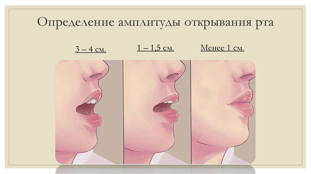 4 рта 4 уха. Степень открывания рта. Ограничение открывания рта степени. Определение степени открывания рта.