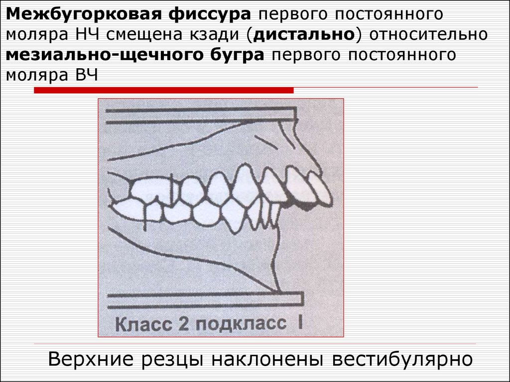 Бугры моляров верхней челюсти. Мезиально-щечный бугор первого моляра верхней челюсти. Дистальнощесный бугор. Мезиальное перемещение верхних зубов. Мезиальное смещение боковых зубов.