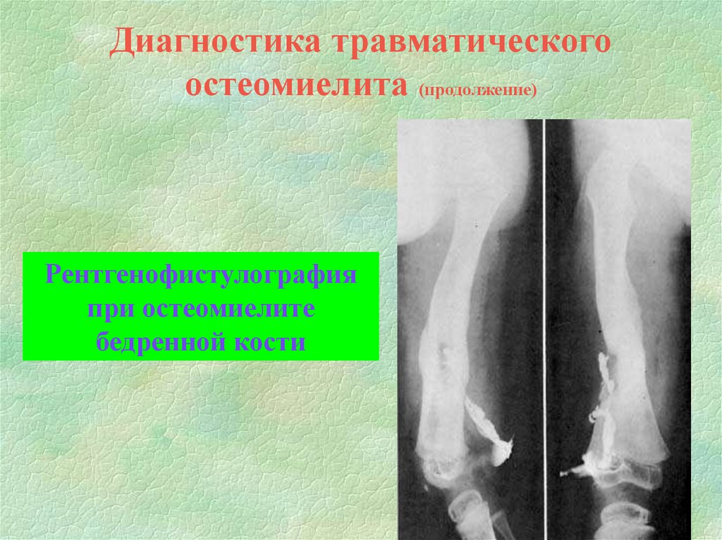 Огнестрельный остеомиелит