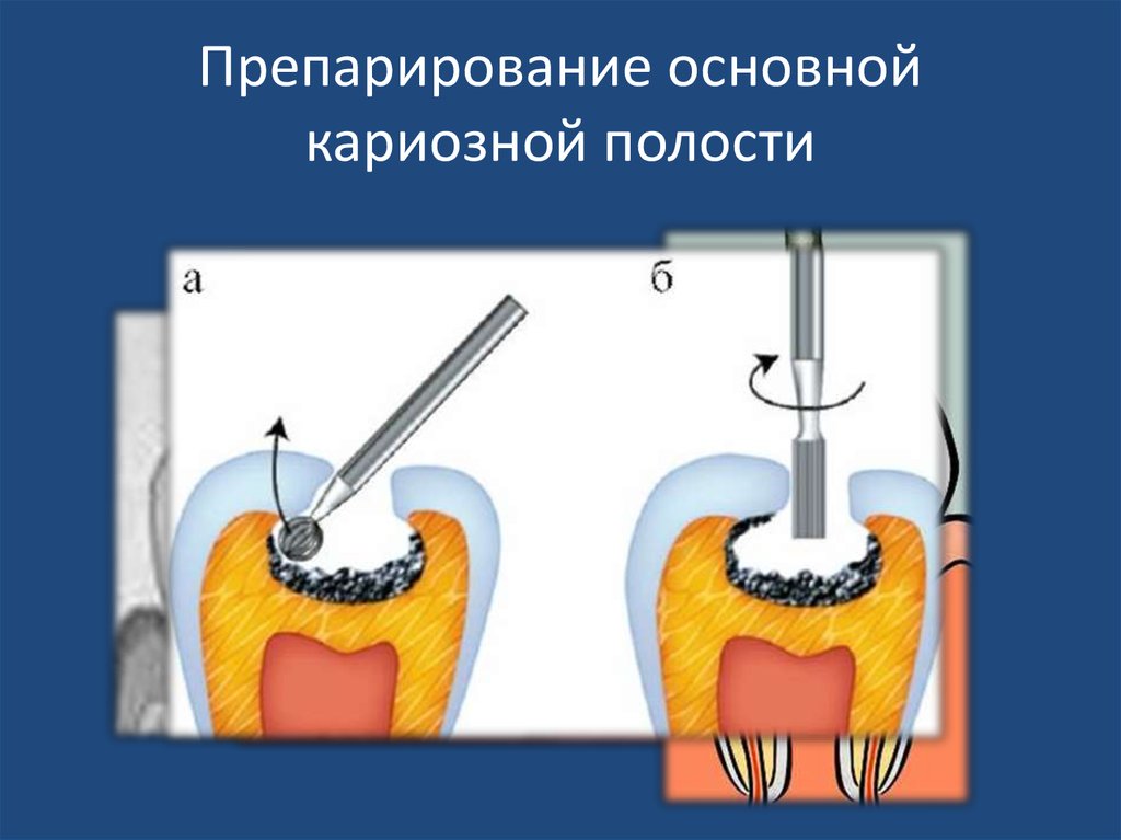 Края кариозной полости. Основные этапы препарирования кариозных полостей. Этапы вскрытия кариозной полости. Этапы раскрытия кариозной полости.