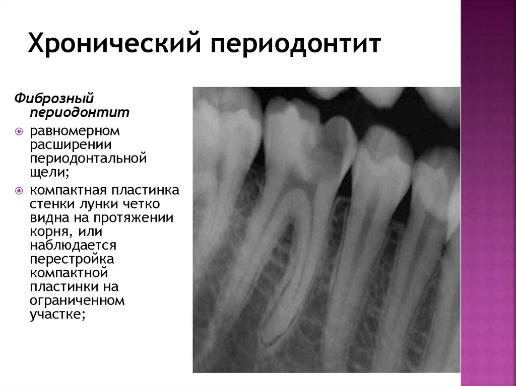 Хронический гранулирующий периодонтит план лечения