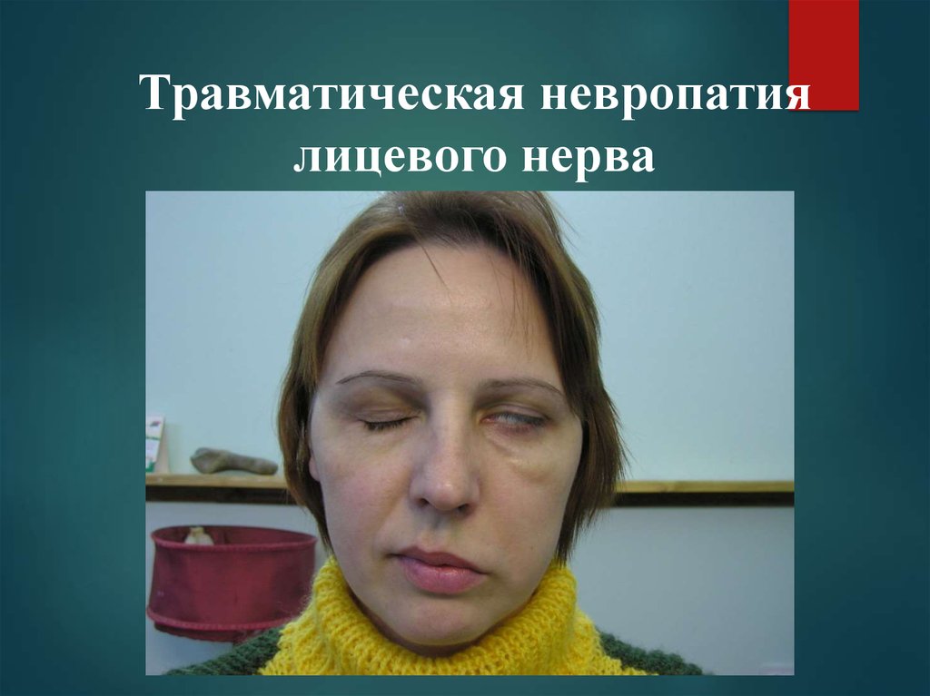 Лечения лицевой невропатия