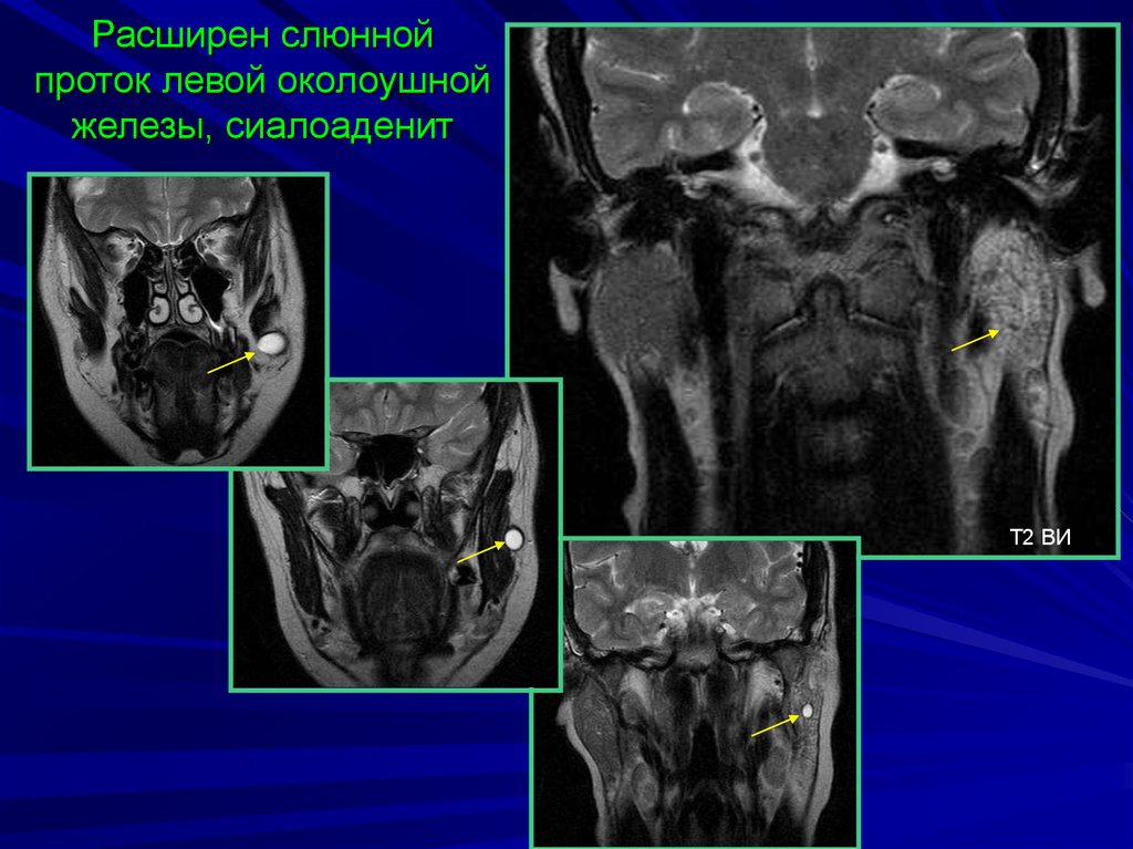 Расширение протоков. Сиалоаденит околоушной слюнной железы мрт. Сиалоаденит околоушной слюнной железы на кт. Проток поднижнечелюстной слюнной железы на кт. Киста околоушной железы мрт.