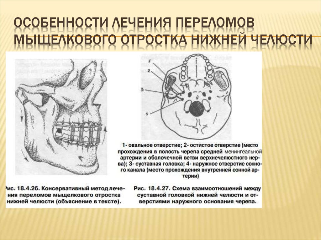Мыщелок челюсти. Перелом шейки мыщелкового отростка. Перелом мыщелкового отростка челюсти. Перелом суставного отростка челюсти. Перелом мыщелкового отростка нижней.