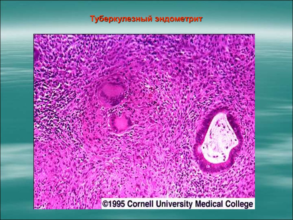 Септический эндометрит. Хронический сальпингит гистология. Туберкулез матки микропрепарат. Хронический эндометрит гистология. Туберкулез фаллопиевой трубы микропрепарат.