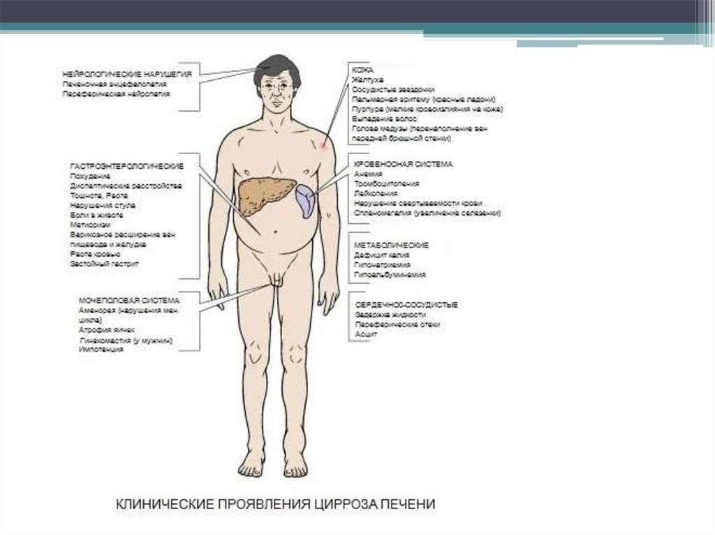 Как начинается цирроз печени у женщин. Клинические проявления при циррозе печени. Схема основных проявлений цирроза печени. Цирроз печени симптомы картинки. Внешний вид человека с циррозом печени.