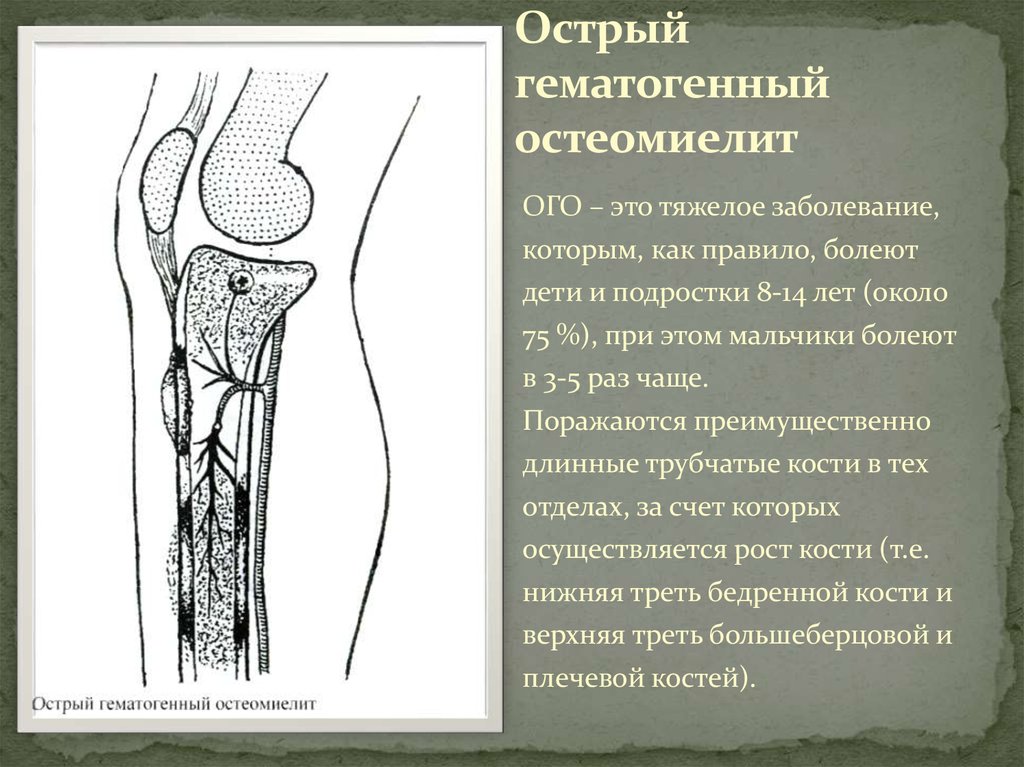 Гематогенный остеомиелит. Гематогенный остеомиелит суставного отростка. Гематогенный Гнойный остеомиелит. Гематогенный путь остеомиелита. Острый остеомиелит бедренной кости схема.