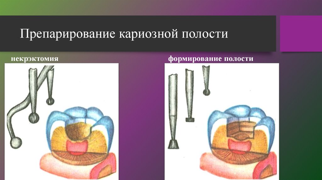 Края кариозной полости. Препарированиеткариозной полости. Этапы формирования кариозной полости. Препарирование кариозных полостей. Этапы раскрытия кариозной полости.