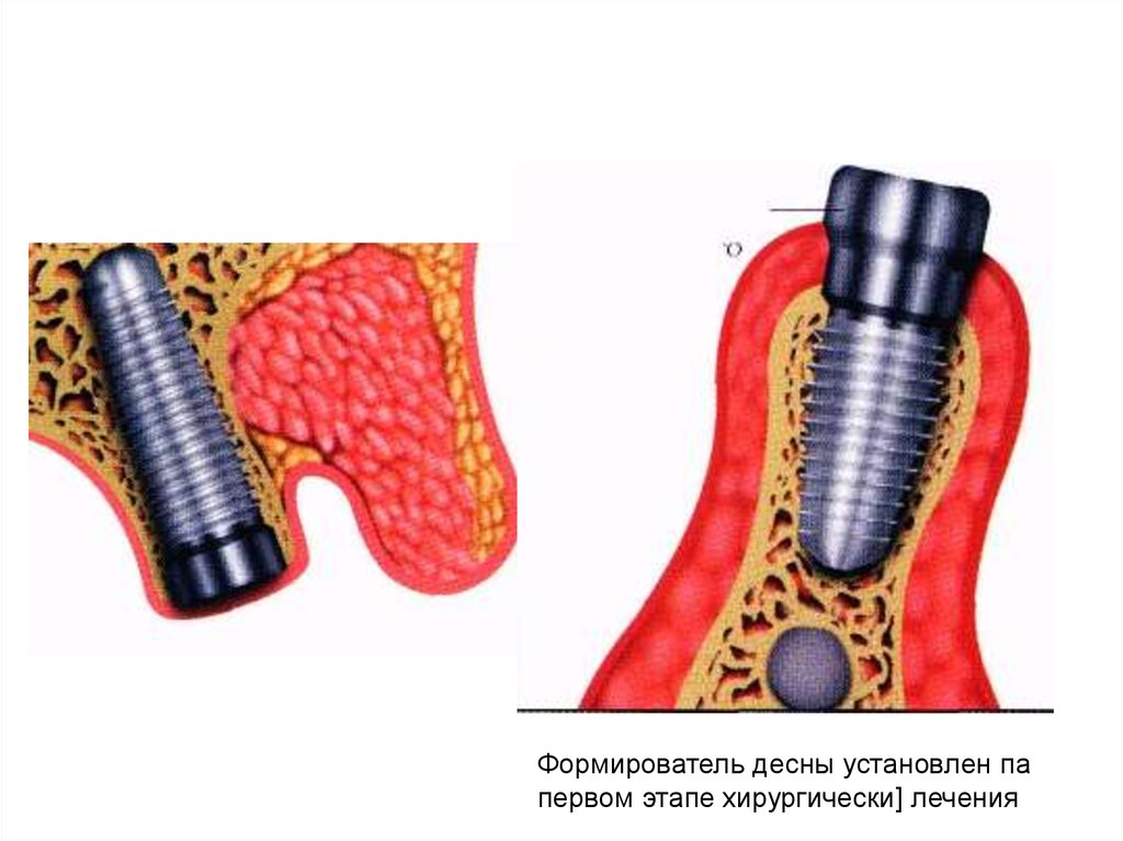 Установка формирователя десны