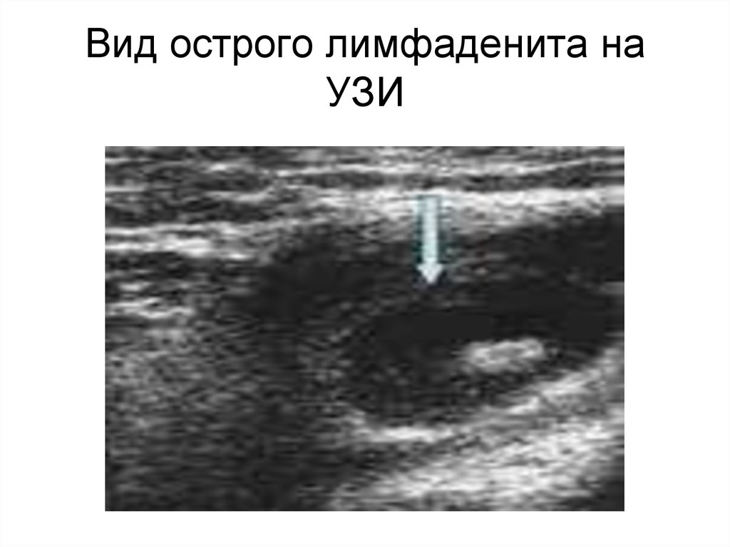 Узи периферических лимфоузлов