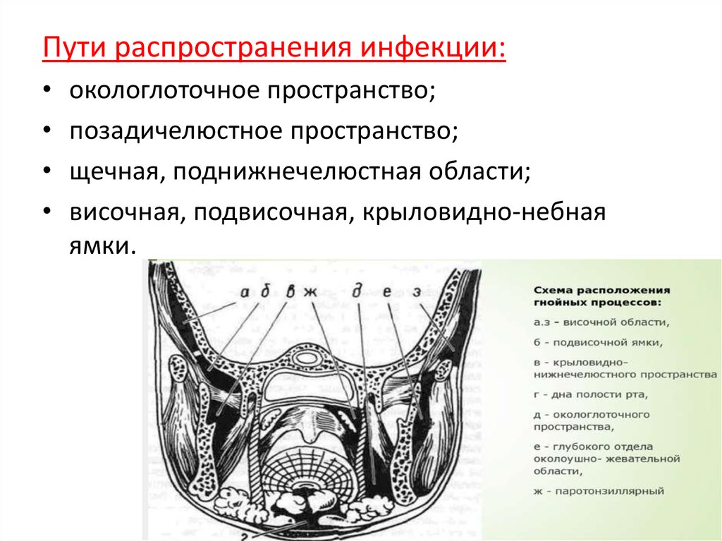 Крыловидно нижнечелюстное пространство. Пути распространения инфекции из поднижнечелюстной области. Крыловидно челюстное пространство. Крыло-челюстное клетчаточное пространство.