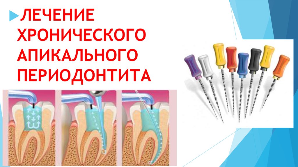 Лечение хронических форм периодонтита. Хронический апикальный периодонтит. Классификация периодонтитов. Хронический апикальный периодонтит мкб.