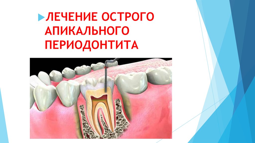 Периодонтите зуба острый лечение. Хронический апикальный периодонтит 47. Острый апикальный периодонтит. Апикальный периодонтит БДУ. Апикальный (верхушечный) периодонтит.