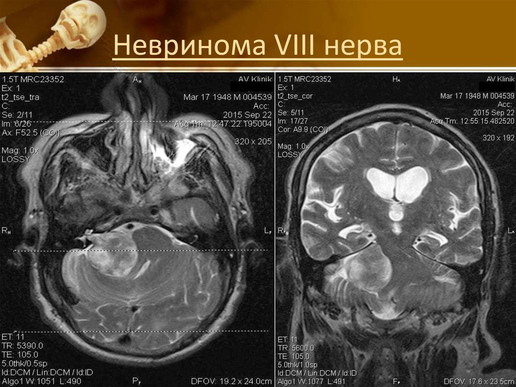 Невринома. Невринома слухового нерва кт. Невринома VIII Черепного нерва. Невринома преддверно-улиткового нерва мрт. Невринома 8 пары ЧМН.