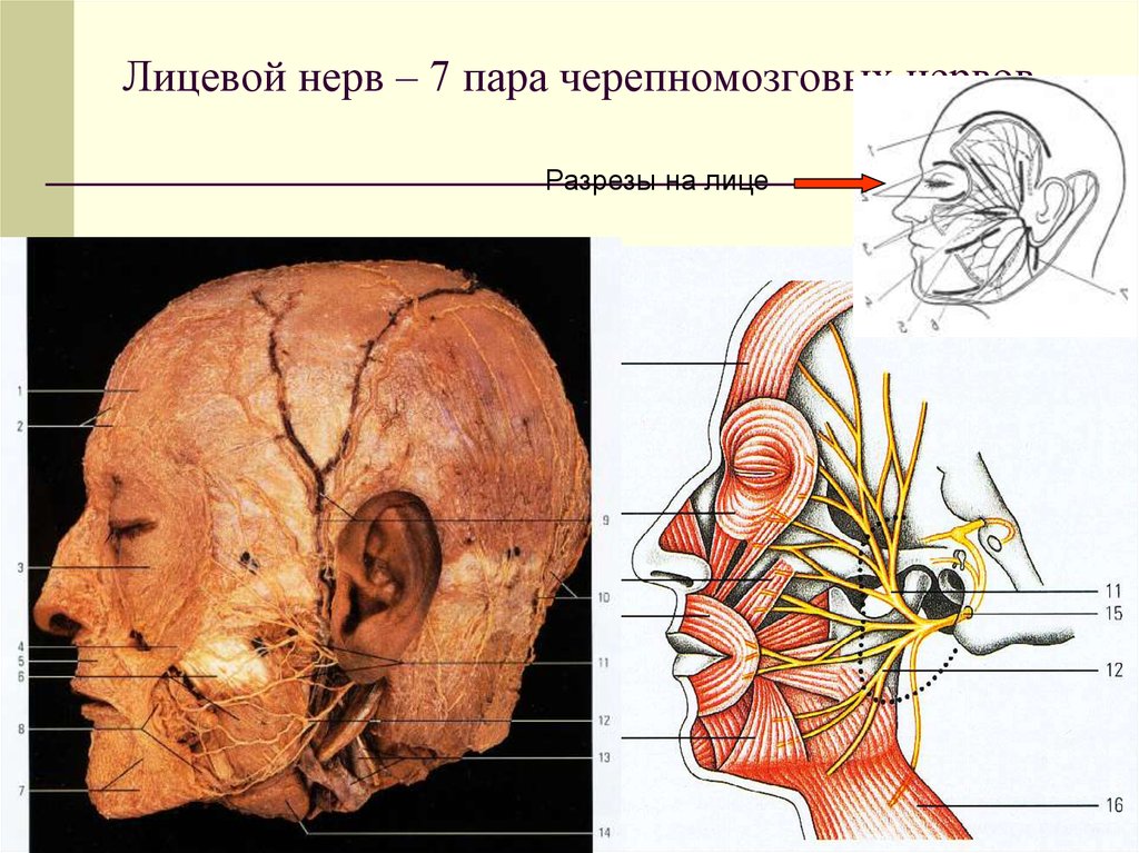 2 лицевой нерв. Лицевой нерв препарат анатомия. 7 Пара лицевой нерв. Лицевой нерв внутри черепа. VII- пара лицевой нерв - анатомия.