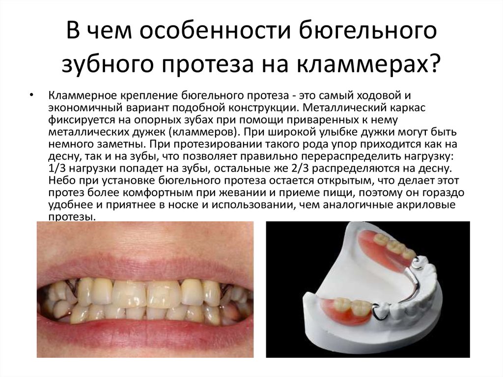 Бюгельный протез отзывы