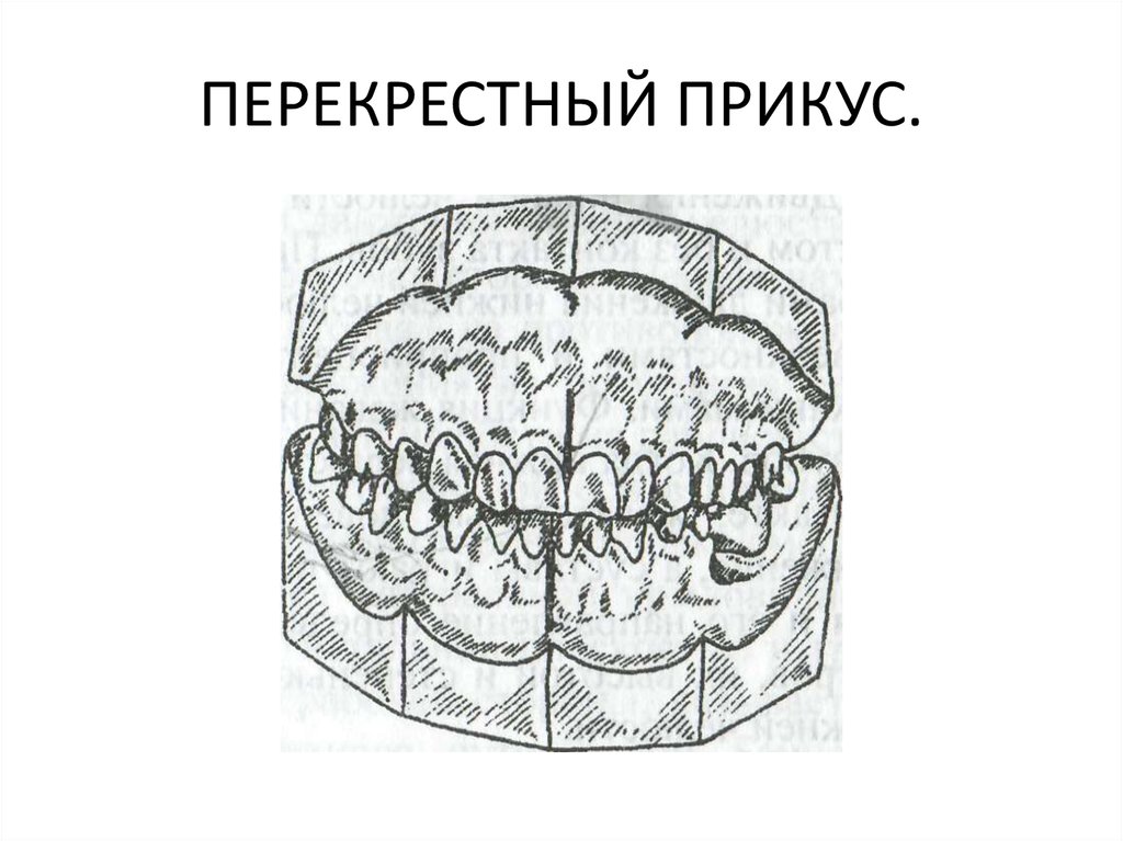 Перекрестный прикус схема лечения у взрослого