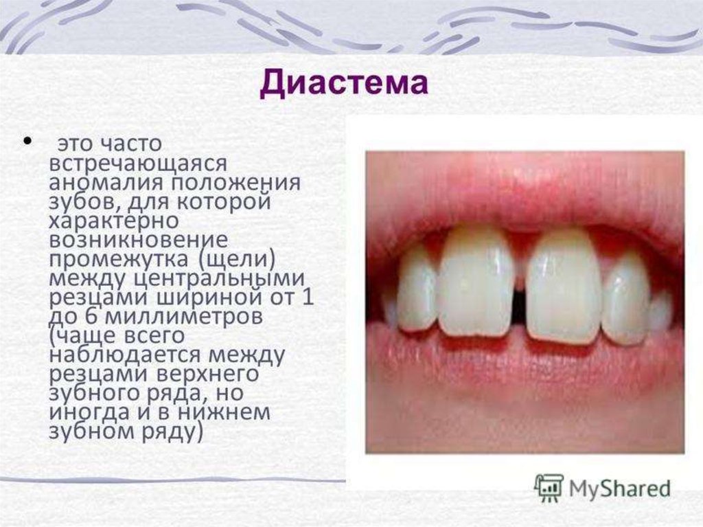Почему зубы отличаются между собой у разных. Физиологические тремы и диастемы.
