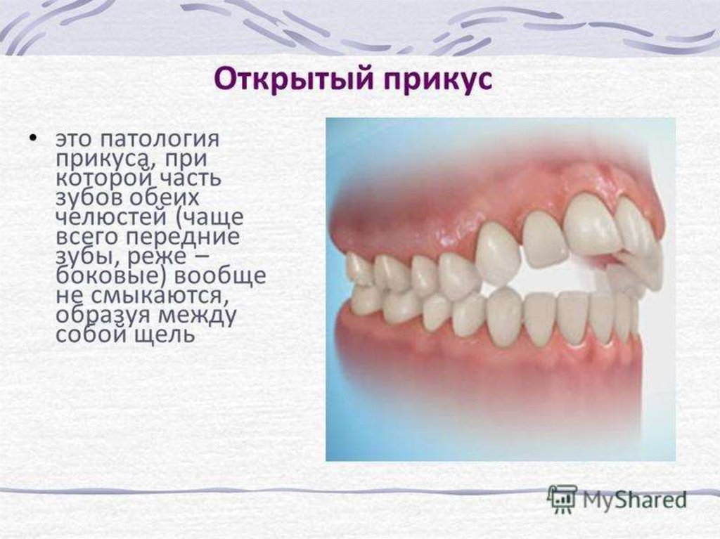 Прикус это. Аномалии прикуса открытый прикус. Открытый фронтальный прикус. Передний и боковой открытый прикус. Аномалии окклюзии открытый прикус.