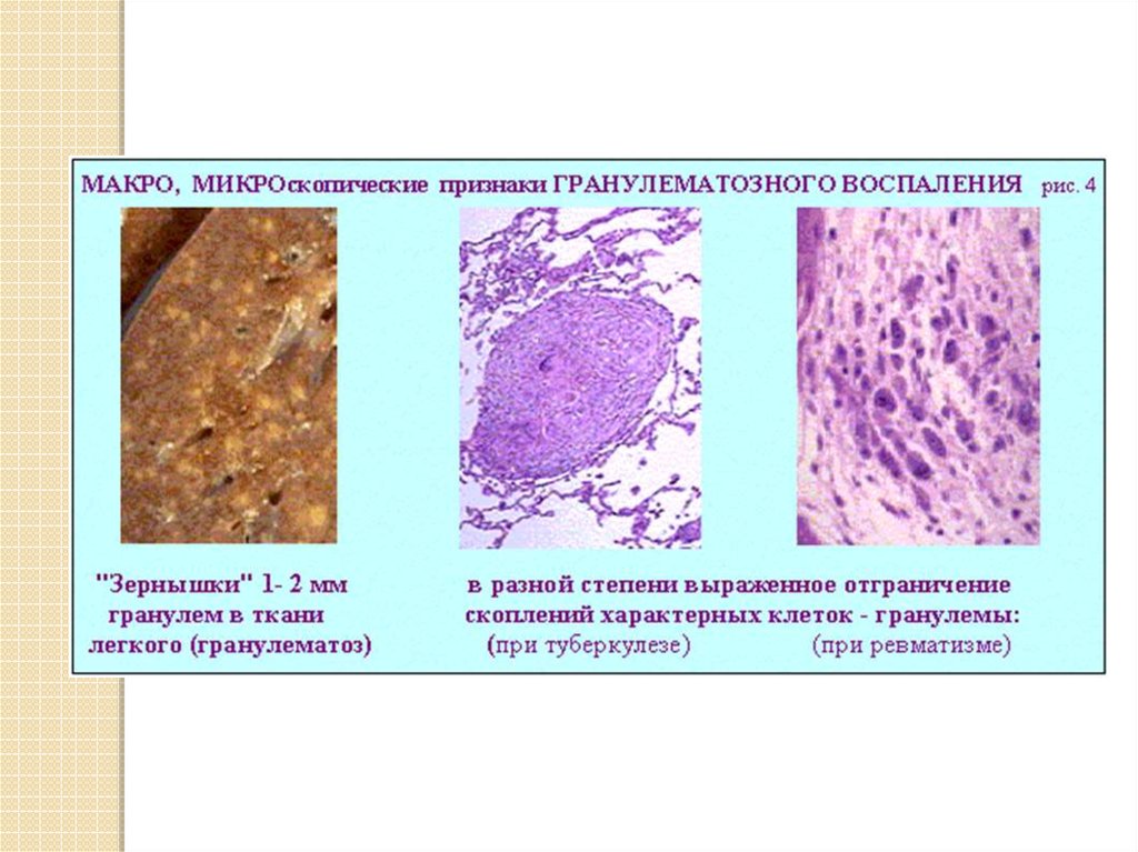 Микроскопические параметры. Пролиферативное воспаление патанатомия. Пролиферативное гранулематозное воспаление. Гранулематозное воспаление патологическая анатомия. Гранулематозное пролиферативное воспаление патанатомия.