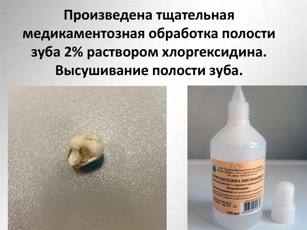 Ванночки хлоргексидином после удаления зубов как делать